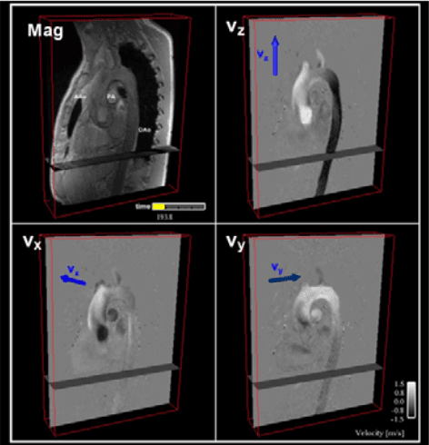 Magnitude image and three velocity-component views from 4D Flow MRI data