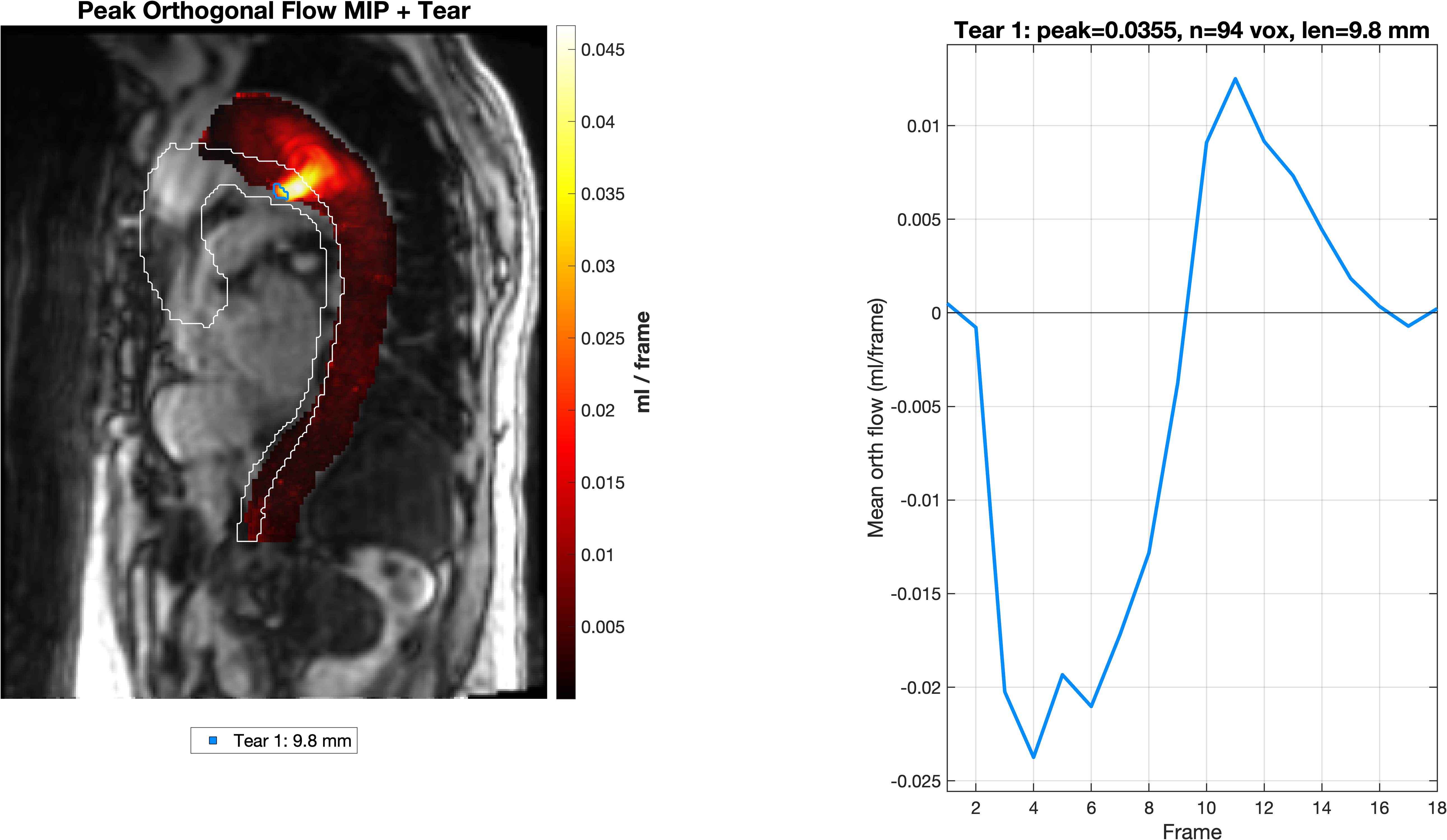 Detector output showing localized tear and flow-time curve