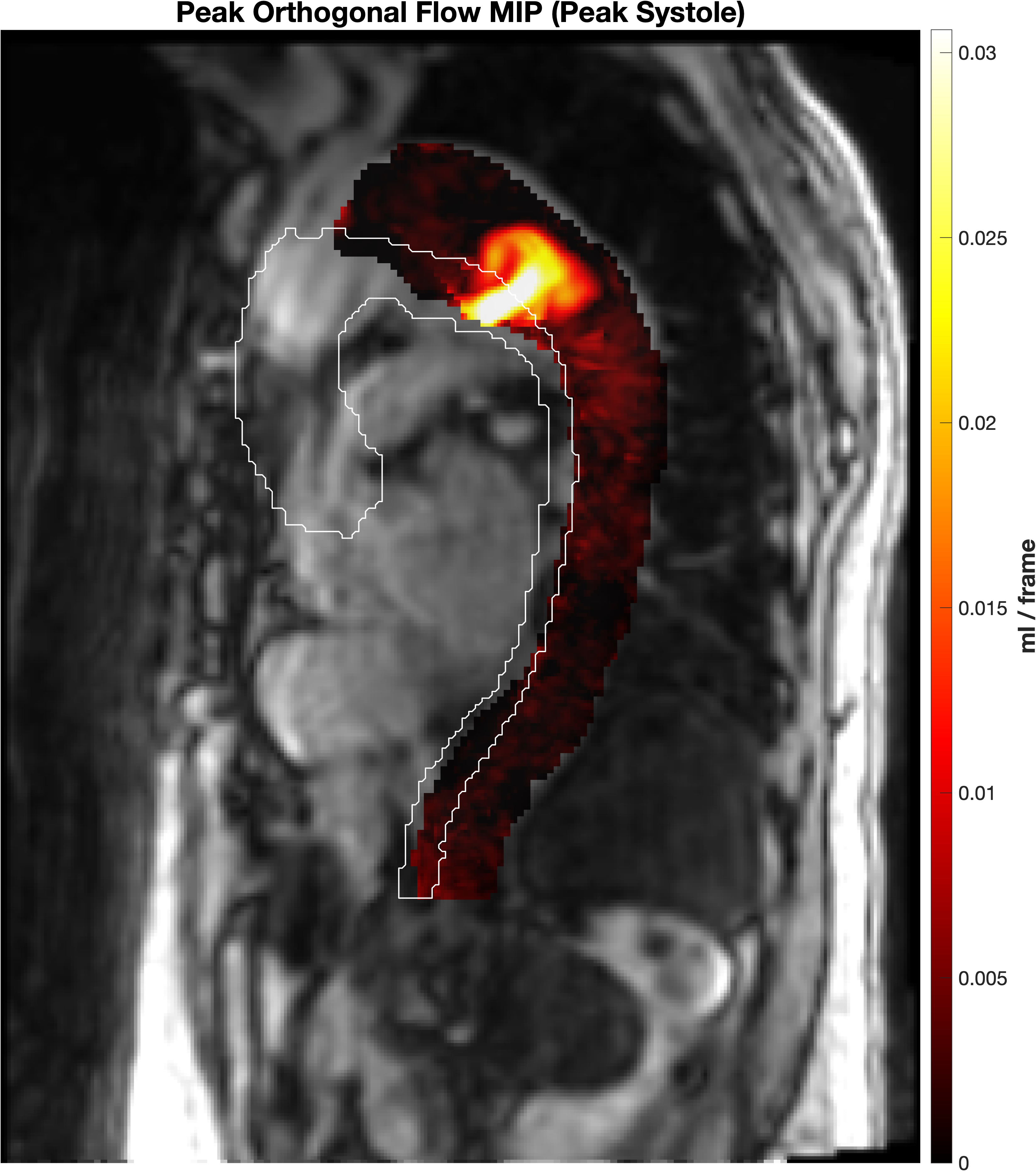 Peak orthogonal flow visualization highlighting a candidate tear region.